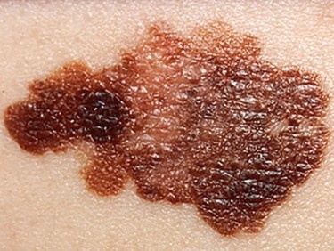 Hautkrebs: Früherkennung entscheidend