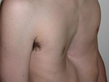 Trichterbrust – wenn die Brust ein «Loch» hat