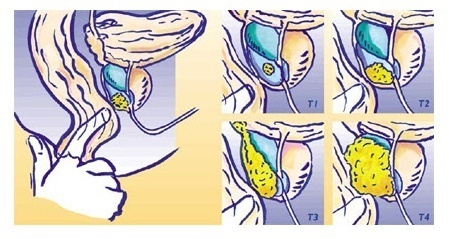 Prostata-Untersuchung