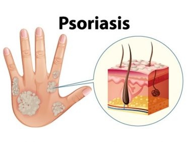 Psoriasis: plus qu'un simple problème de peau