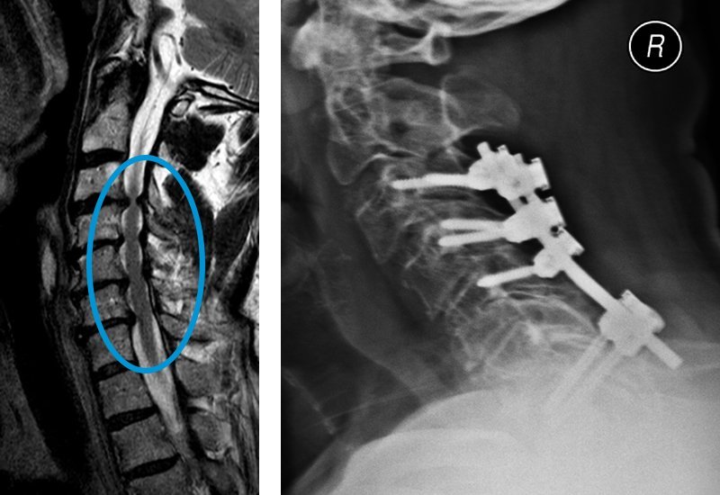 Röntgenbilder eingeklemmtes Rückenmark vor und nach der Operation