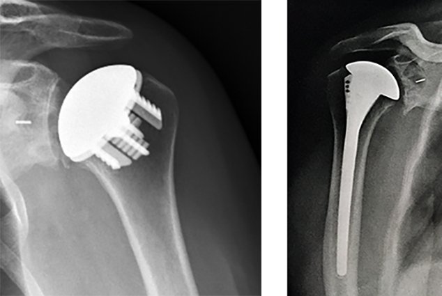Radiographies d'une prothèse de l'épaule sans tige et avec tige