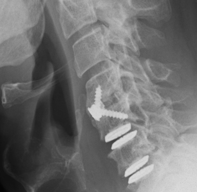Röntgenbild HWS mit Kombination von starren und beweglichen Platzhaltern