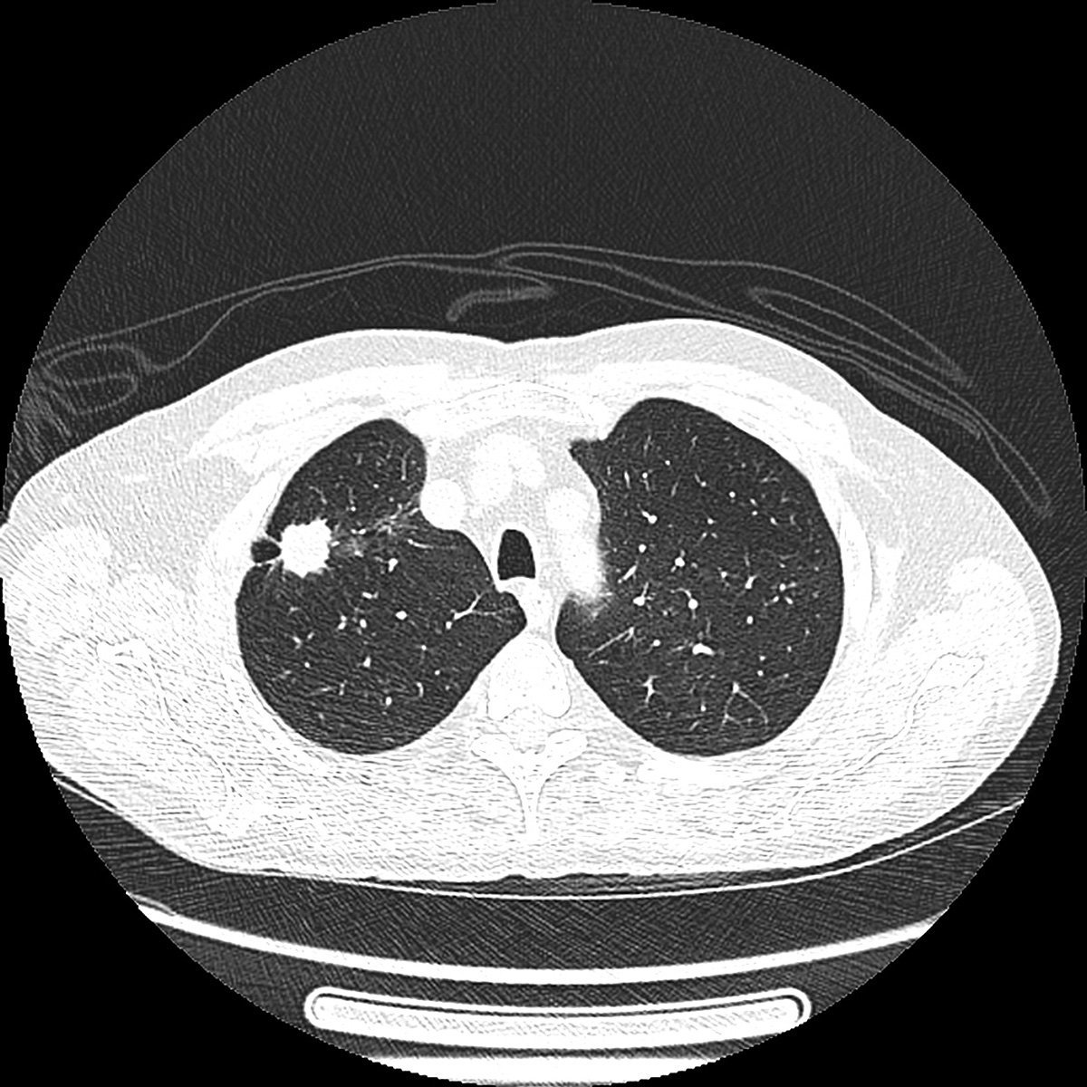 CT-scan d'une tumeur maligne du poumon